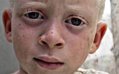 Exposición: “Albinismo”